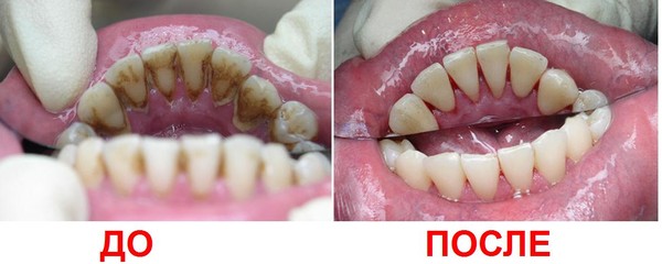 поддесневой зубной камень фото онлайн