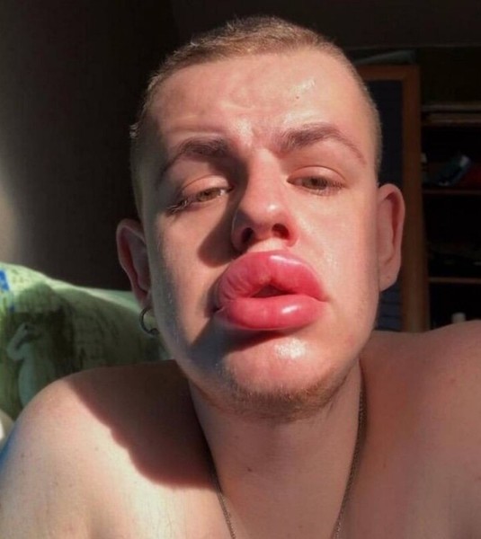 Мужчина с накаченными губами