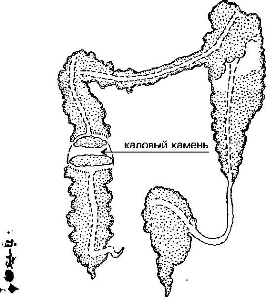 Каловые массы в кишечнике. Каловый камень в толстой кишке. Каловый камень в прямой кишке.